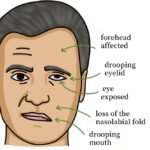 facial nerve palsy surgery
