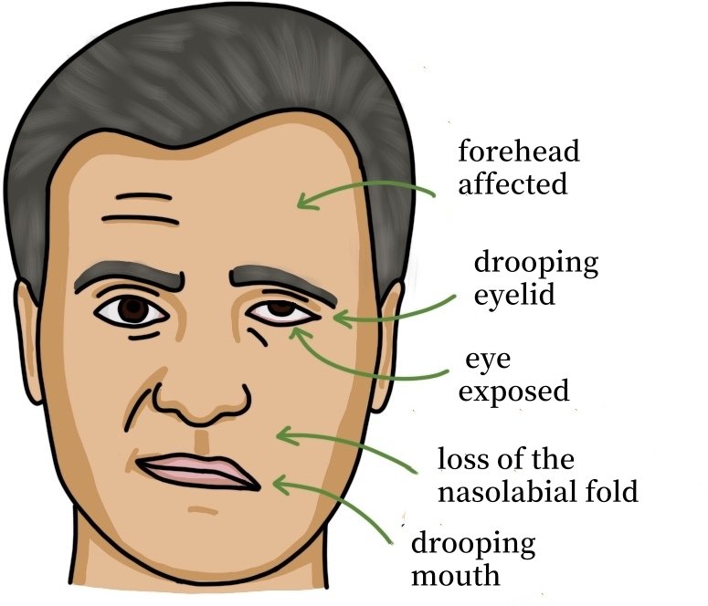 facial nerve palsy surgery