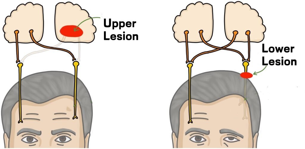 facial nerve palsy surgery